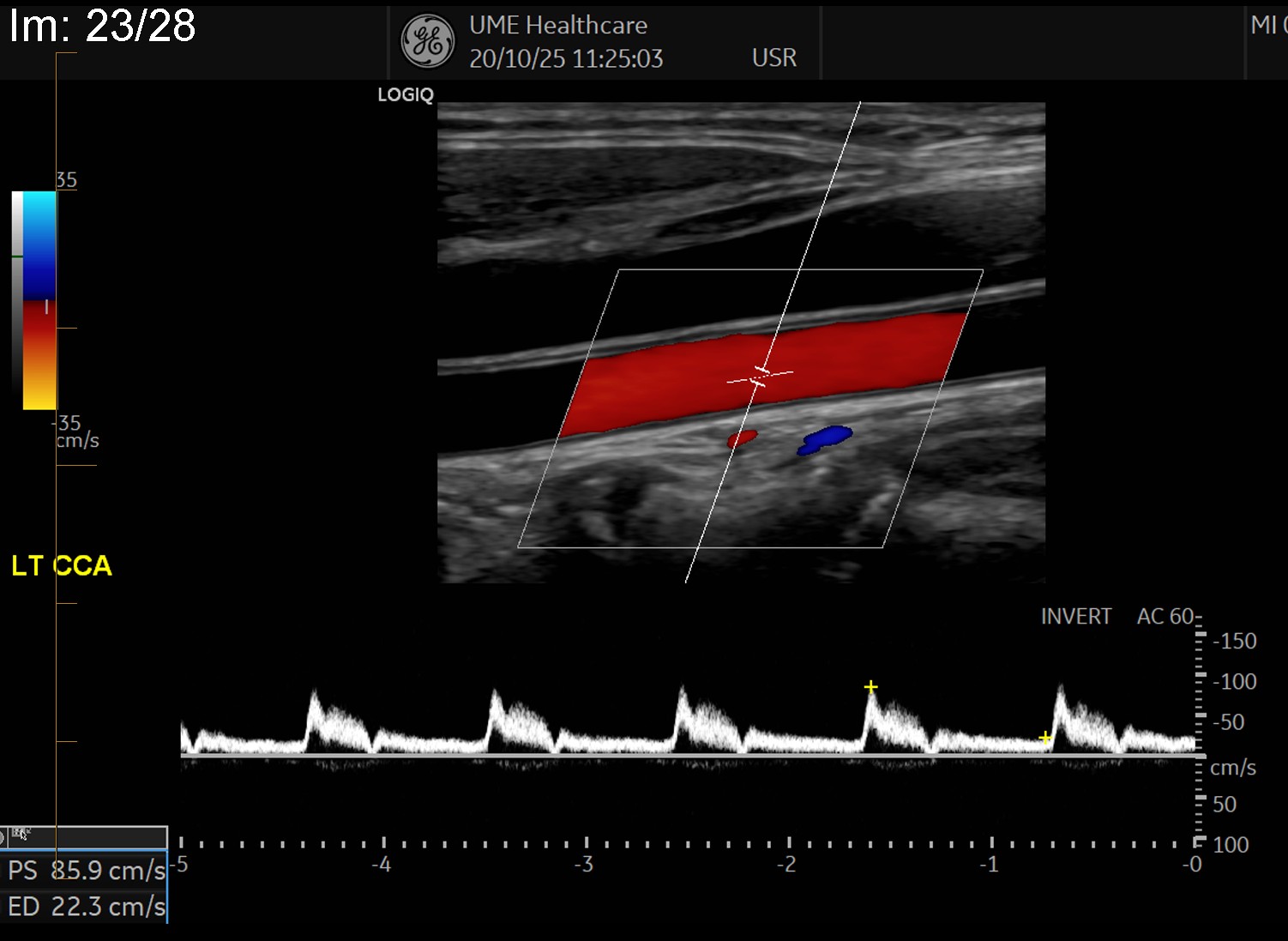 A carotid Doppler ultrasound of the neck arteries.