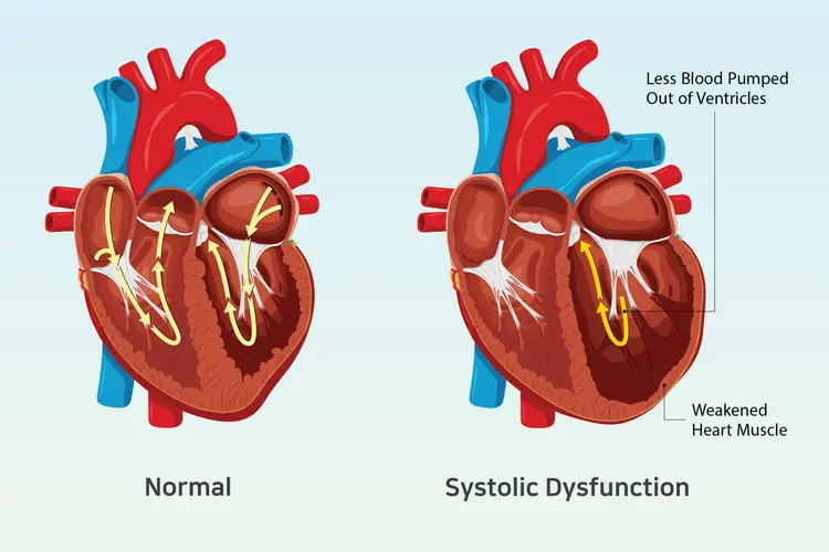 An illustration explaining a common heart condition.